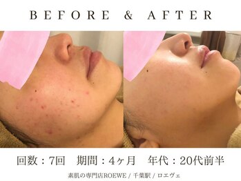 ロエヴェ(ROEWE)/ニキビ改善・毛穴ケア・肌質改善
