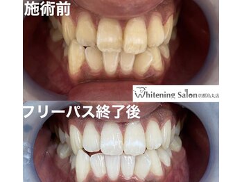ホワイトニングサロン 京都烏丸店/ホワイトニング施術例