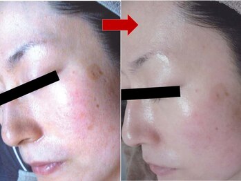 ブリリアン デイスパ 阪急西宮ガーデンズ店(BRILLIAN DAYSPA)/水光ピーリング