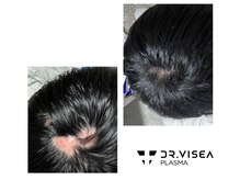 エミリー 守山(EMILY)/【症例写真】プラズマミスト (2)