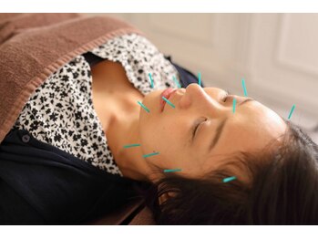 六花鍼灸整骨院 博多駅前店の写真/《創業20年》鍼を使用した施術でたるみ改善、リフトアップなど嬉しい効果◎根本改善でスッキリした印象に♪