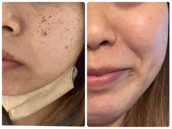 クラージュ/しみケア