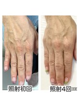 リリー(Lilly)/ルビッシュの効果