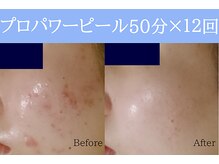 空 荻窪(くう)/プロパワーピール6回×2クール