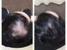 鍼で頭皮の凝り撃退!!【育毛促進＆脱毛緩和】★初回限定¥7,980