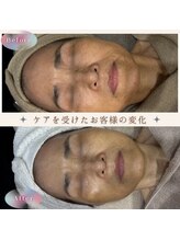 美肌研究所 絹 田辺店/70代女性*ゾンビマスク+ハイドロ