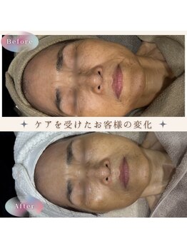 美肌研究所 絹 田辺店/70代女性*ゾンビマスク+ハイドロ