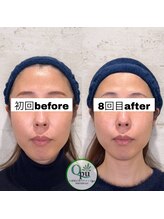 キュープ 相模原淵野辺店(Qpu)/たった4回で人生で1番小さな顔に