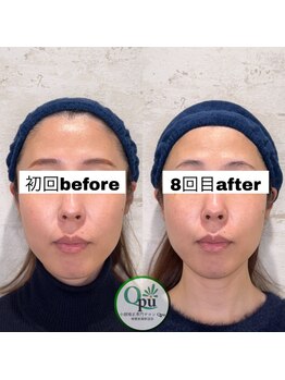 キュープ 相模原淵野辺店(Qpu)/たった4回で人生で1番小さな顔に