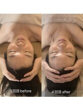 ラペ(La paix)/脳洗浄before/after