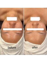 ビースキン(B SKIN)/光フォト