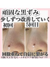 アルムダアクア 天王寺店(Aleumda AQUA)/ハーブピーリング/大阪/天王寺