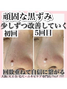 アルムダアクア 天王寺店(Aleumda AQUA)/ハーブピーリング/大阪/天王寺