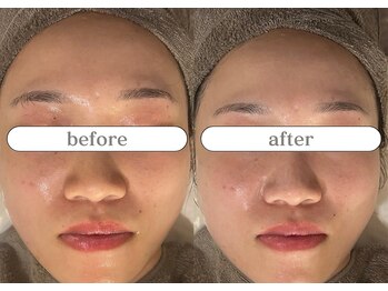 リスタ(RSTA)/【BEFORE/AFTER】