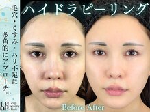毛穴の黒ずみや皮脂汚れを除去しつるんとした素肌へ導きます