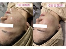 ジョイアビューティー(Gioia beauty)の雰囲気(リジュランのジェネリックで大人ニキビ/毛穴等の改善◎美肌へ♪)