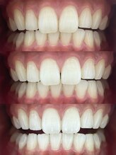 エクシアホワイトニング 日本橋店/白い歯をもっと白く