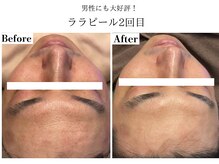 フレイヤ(FREYA)/ララピールBefore→After