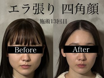 オアシストウキョウ 表参道(OASIS TOKYO)/エラ張り/四角顔のお悩み