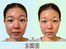 ナチュラルビューティーフェイス 横浜(NBF)/２回目面長・フェイスバランス