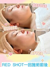 サロン ベル(salon Belle)/RED SHOT半永久二重顎ケア