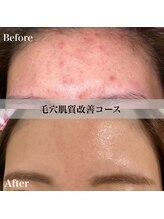 アール アンド ビューティーサロン(Ｒ＆ BeautySalon)/頑固なニキビにはたらきかける！