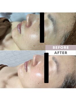 とぅるりん 肌質改善/陶肌トリートメント＊