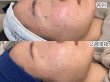 ロイ 初生店(LOI)/ハーブ×プラズマ