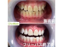 ルブラン 奈良店(Le Blanc)/やっぱり白い歯は清潔です！