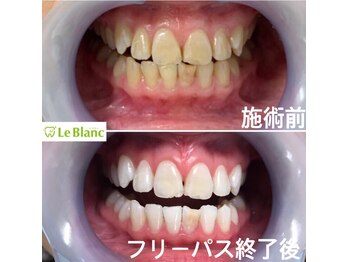 ルブラン 奈良店(Le Blanc)/やっぱり白い歯は清潔です!