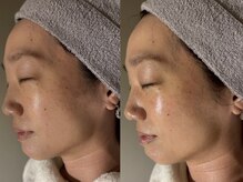 アンティアージュ 福岡本店(antiage)/季節の変わり目でゆらがない肌に