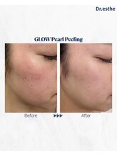 オーシャンブルー 福岡店(OCEAN BLUE フェイシャル&ボディ)/【韓国】グロウパールピーリング