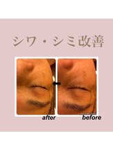 エステティック レイビス 新宿店(RAYVIS)/シミ・シワも改善☆