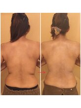 ホワイトセージ(White Sage)/背中施術ビフォーアフター