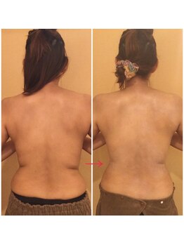 ホワイトセージ(White Sage)/背中施術ビフォーアフター