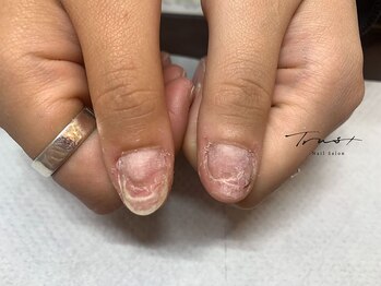 トラストネイル 垂水(TRUST NAIL)の写真/TRUST NAILのフィルインは驚きの長持ち！深爪育成/巻き爪矯正などの爪悩み解決サロン♪実証画像ご紹介中◎