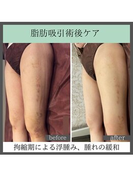 トータルビューティーサロン レビュー(REVIEW)/【Before/After】術後ケア