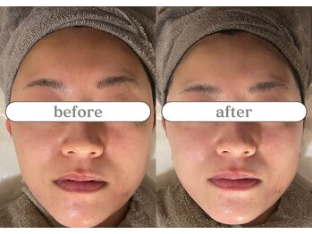 リスタ(RSTA)/【BEFORE/AFTER】