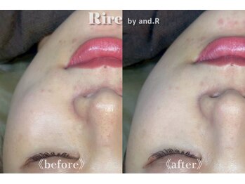 リル バイ アンドアール(Rire by and.R)/イオン導入×美白トリートメント