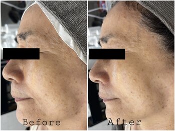 レイズ(RAISE)/シワ・たるみケア　ゾンビマスク