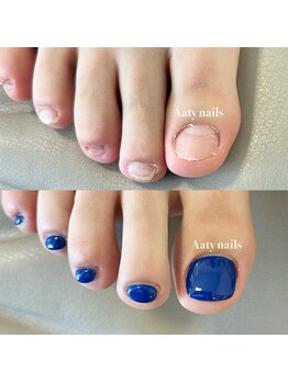 アーティネイルズ(Aaty Nails)/当日から見た目改善