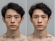 ミネルバ(MINERVA)/施術例 30代男性　フェイシャル