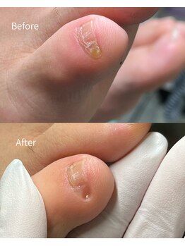 巻き爪補正店 千葉店/