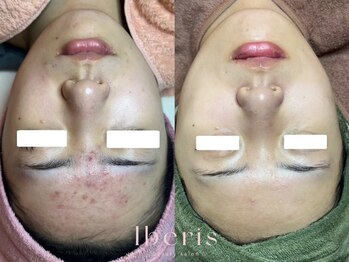 サロンエス 麻布十番(salon.S)の写真/医療提携ブランドのTIPハーブピーリング。ニキビ・毛穴・美白ケアまで、エビデンス重視で続ける肌管理！