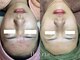 サロンエス 麻布十番(salon.S)の写真/医療提携ブランドのTIPハーブピーリング。ニキビ・毛穴・美白ケアまで、エビデンス重視で続ける肌管理！