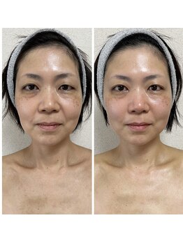 ハンナリ(Hannari)/骨格調整、筋膜リリース、小顔