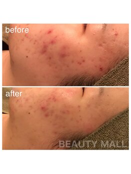 ビューティーモール(BEAUTY MALL)/ハーバルピール(レベル4)1回施術