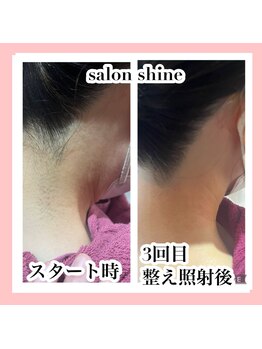 サロンシャイン(Salon Shine)/うなじ脱毛のデザイン