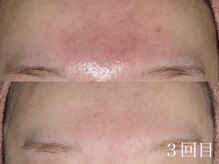 ホワイトアクア 中目黒店(WHITE AQUA)/ララピール/赤みケア/中目黒