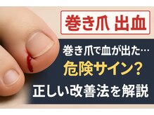 巻き爪じゅん 千葉駅前店/巻き爪で出血、正しい改善方法